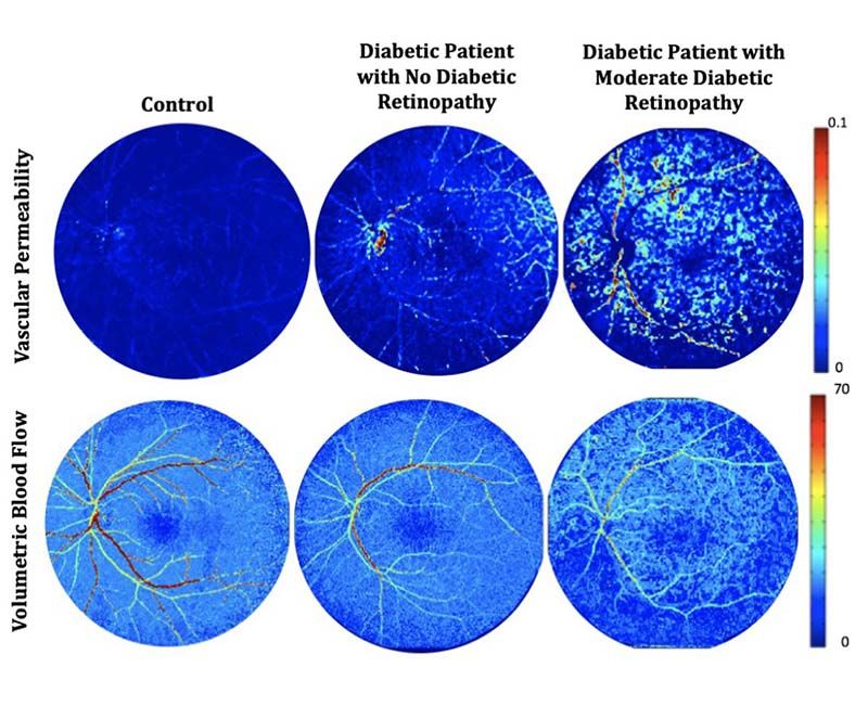 Retinopathy